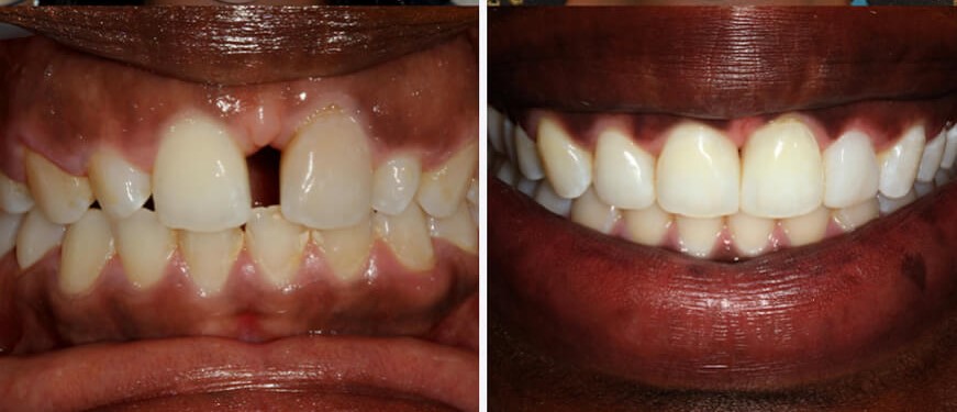 Orthodontic alignment before and after result